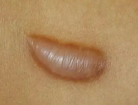 增生性疤痕